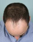 Before Hair Transplant&nbsp;Front